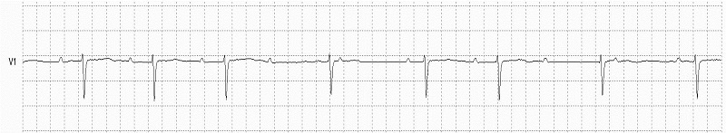 Complete AV Block